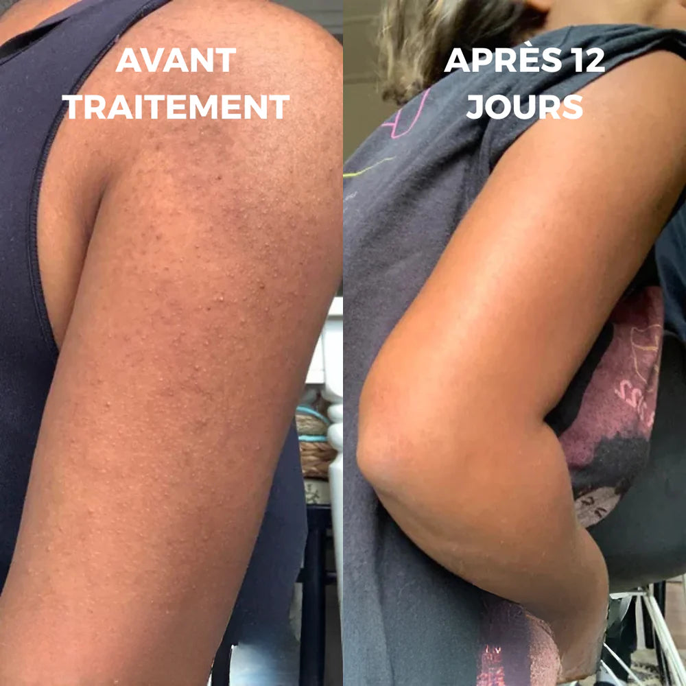 Crème Anti-Peau de Fraise –  Débarrassez-vous de la honte